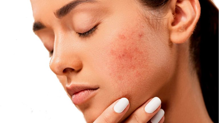 Read more about the article Oily Skin Care – How to Prevent Youthful Pimples